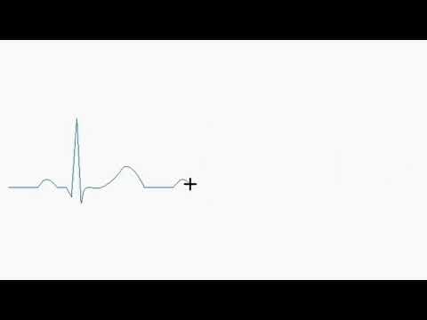Normal Sinus ECG